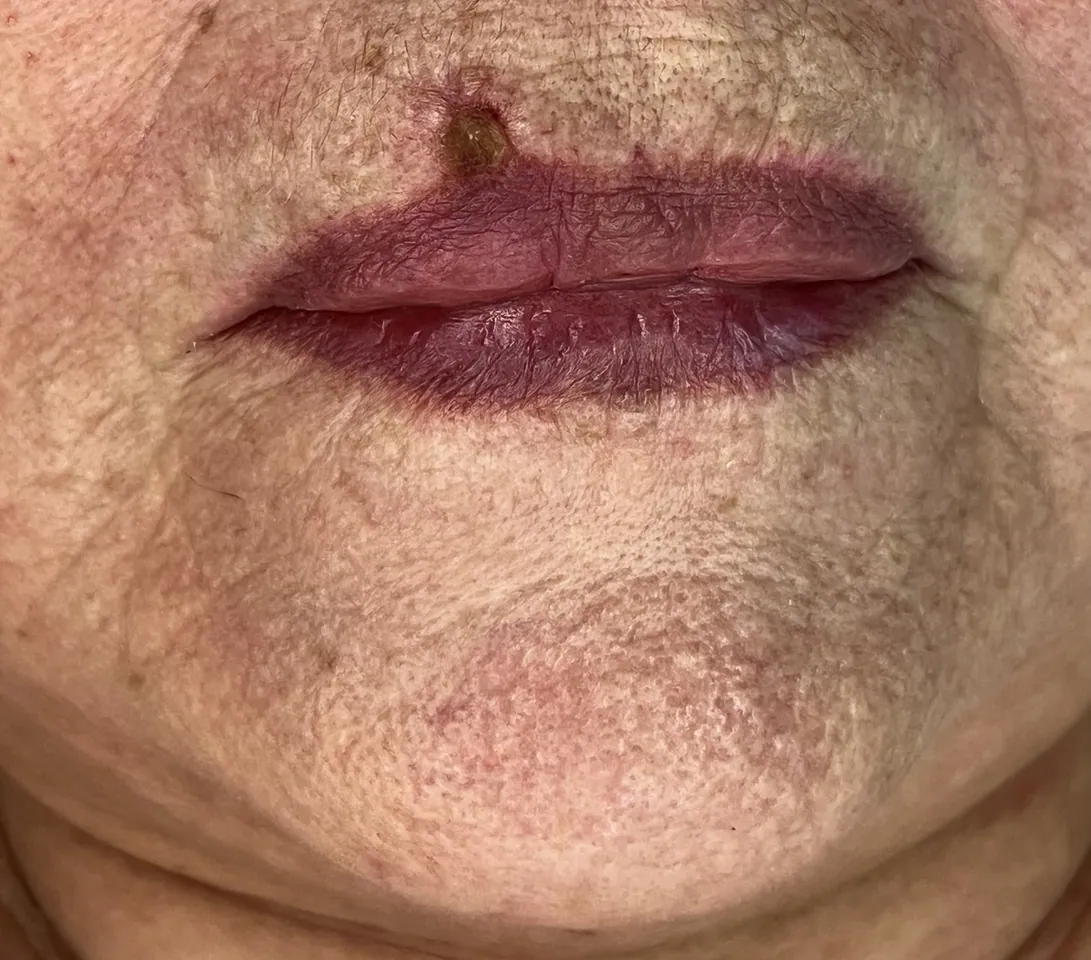 Lesión en el labio